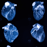 coronary